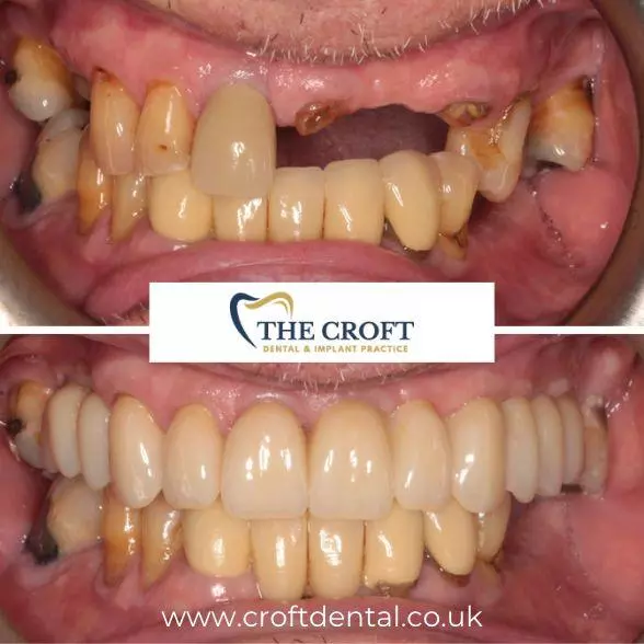 Dental implants before and after 2