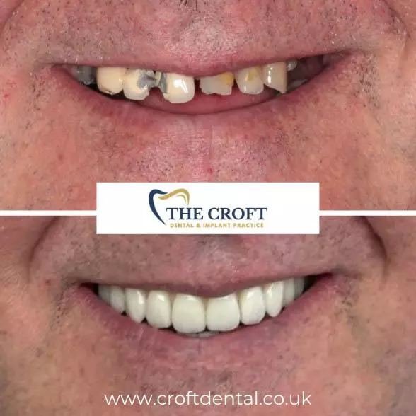 Dental implants before & After Wilmslow
