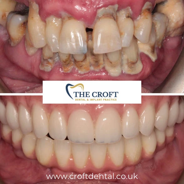 Full Mouth Rehab Before & After Wilmslow