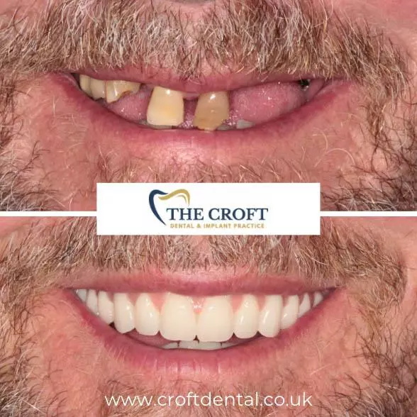 Dental implants before & After Cheshire