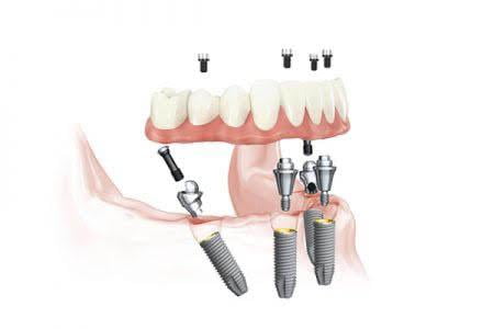 All on 4 dental implants wilmslow