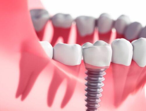 How Soon After An Extraction Can You Have A Dental Implant?