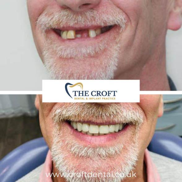 Dental Implants before and after 2