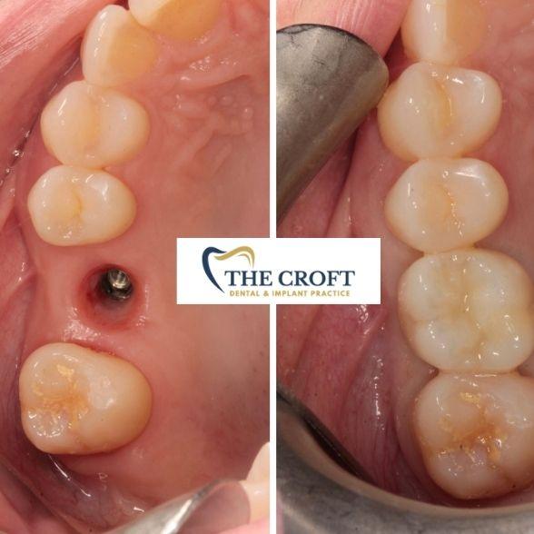 Dental Implants Before & After 10