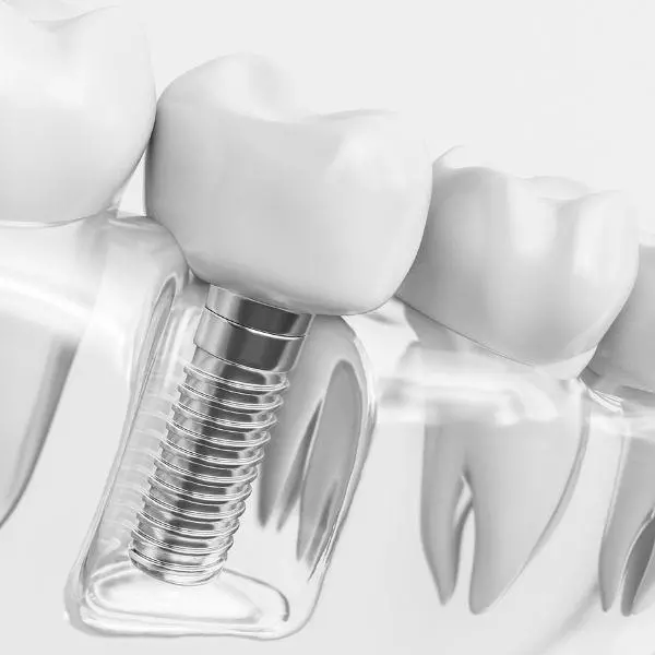 Dental implants wilmslow