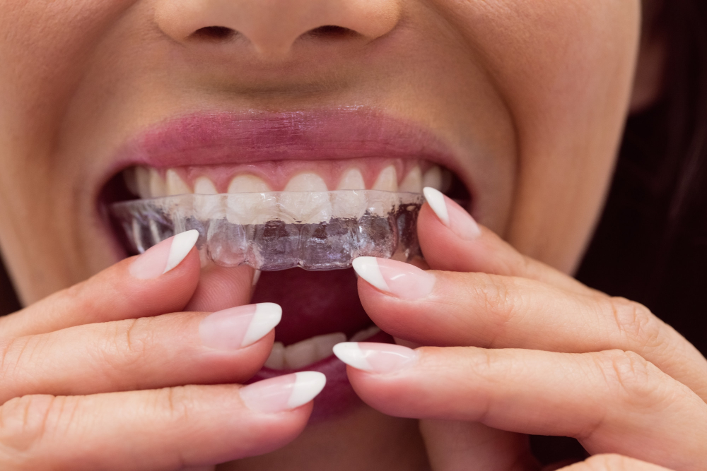 Invisalign Invisalign